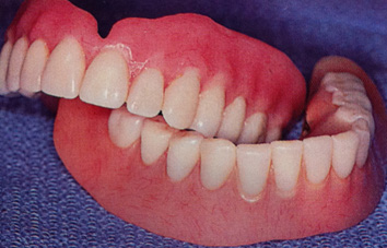 32 Smile Stone Complete Dentures